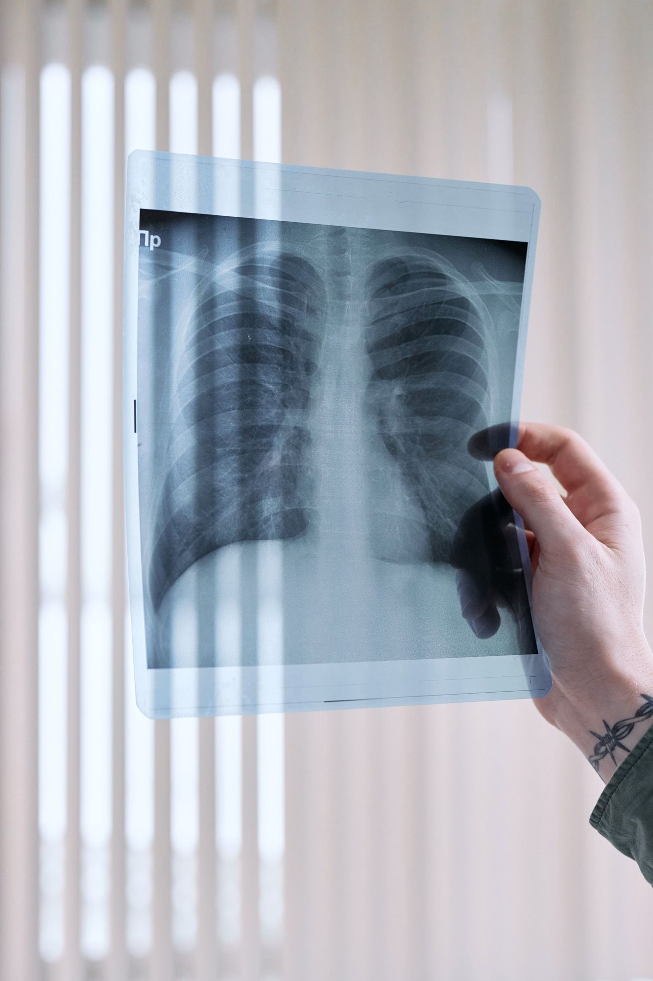 A chest X-ray showing both lungs, held up to the light