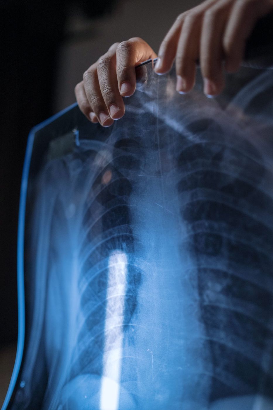 Hands holding up a chest X-ray